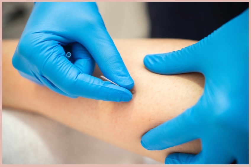All Womens Health - Dry Needling